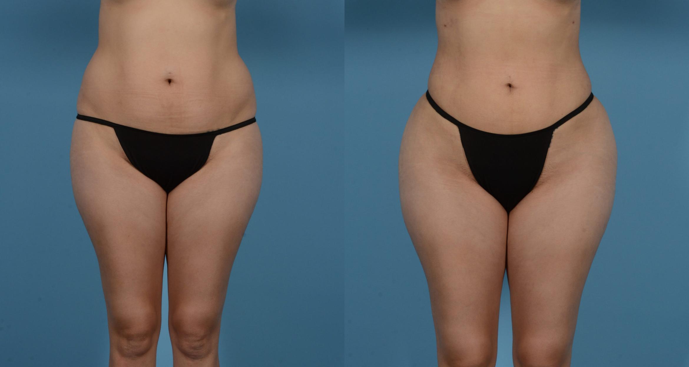 Before & After Liposuction Case 613875209999 View 1 View in Houston, TX