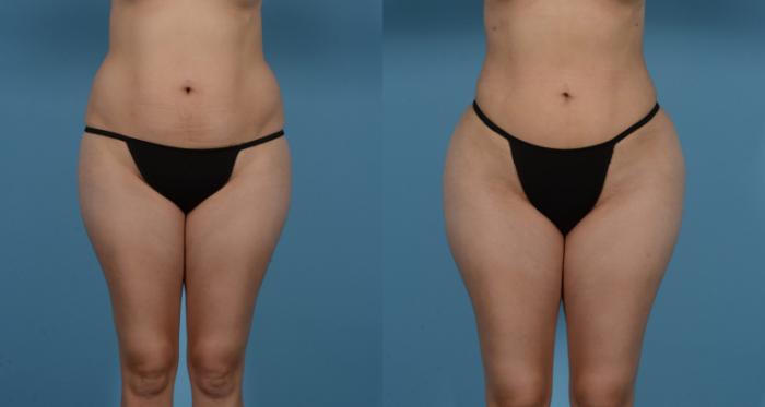Before & After Liposuction Case 613875209999 View 1 View in Houston, TX