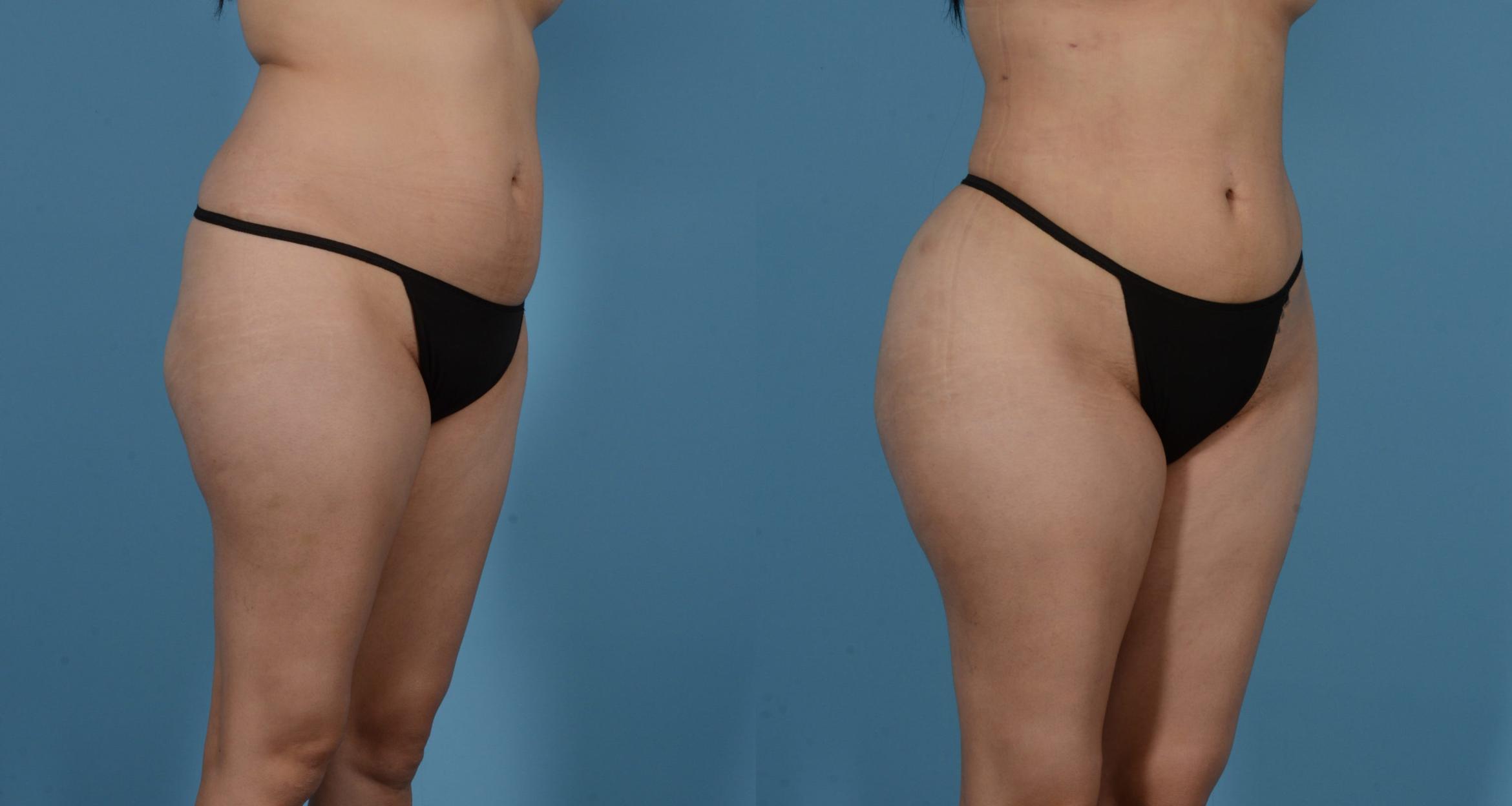Before & After Liposuction Case 613875209999 View 2 View in Houston, TX