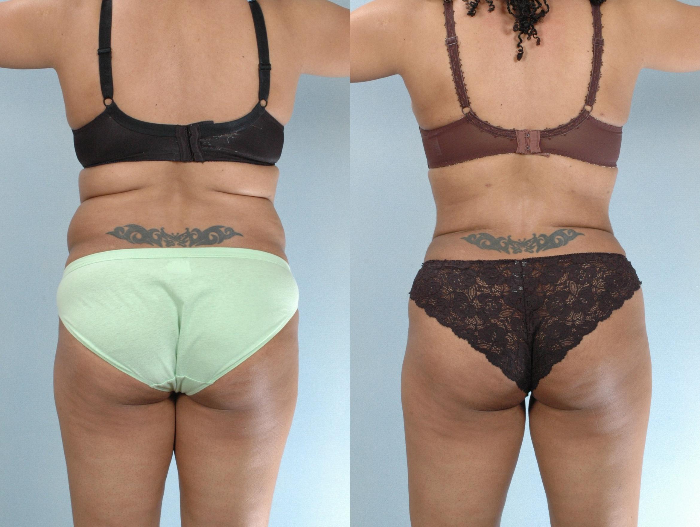 Before & After Liposuction Case 613875210004 Back View in Houston, TX
