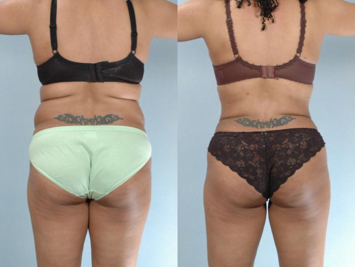 Before & After Liposuction Case 613875210004 Back View in Houston, TX
