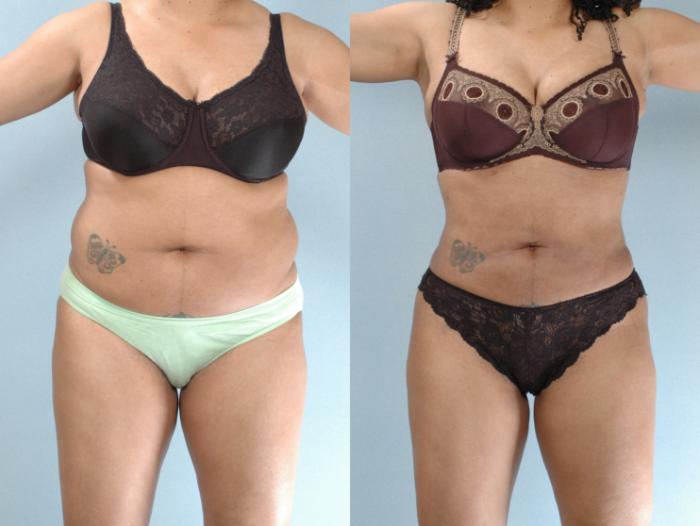 Before & After Liposuction Case 613875210004 Front View in Houston, TX