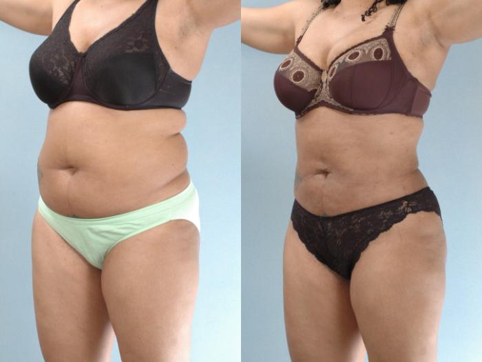 Before & After Liposuction Case 613875210004 Left Oblique View in Houston, TX