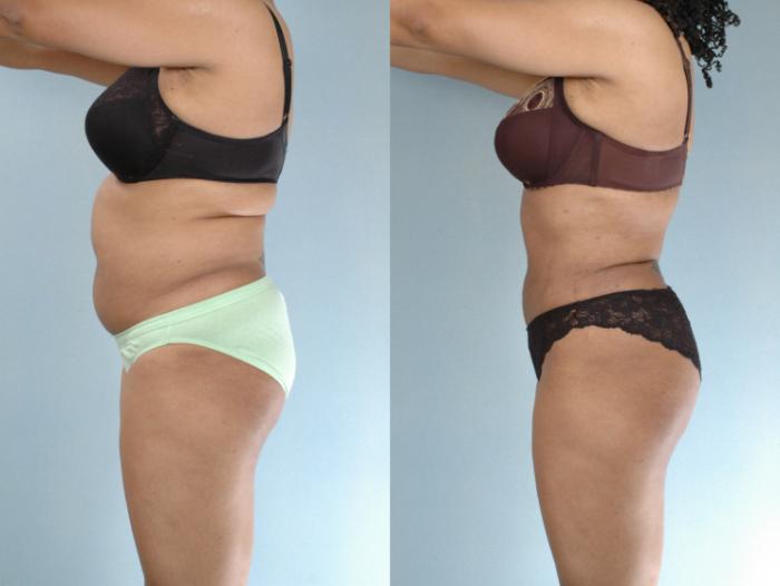 Before & After Liposuction Case 613875210004 Left Side View in Houston, TX
