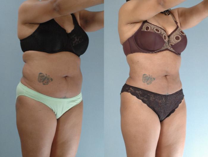 Before & After Liposuction Case 613875210004 Right Oblique View in Houston, TX