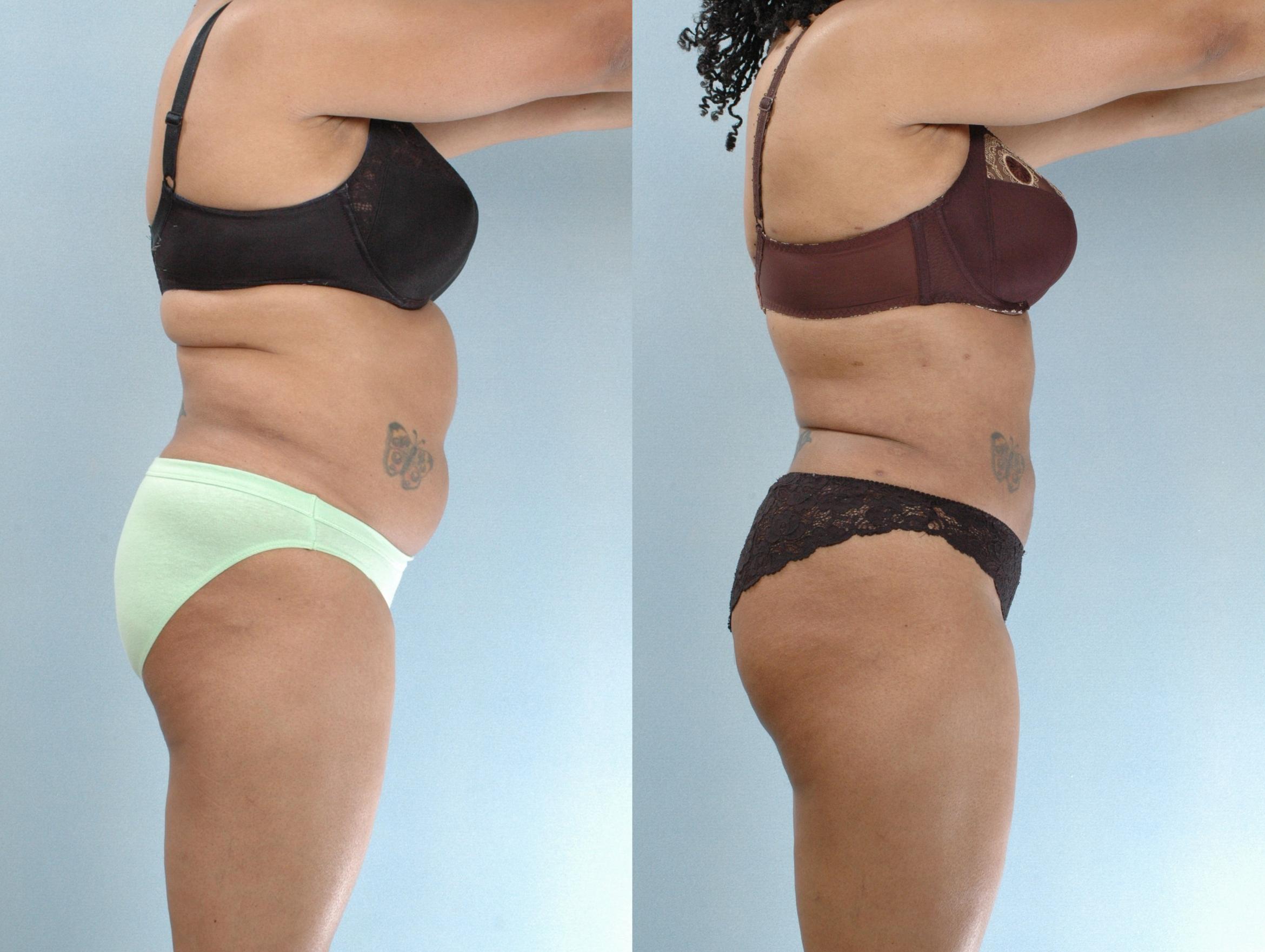 Before & After Liposuction Case 613875210004 Right Side View in Houston, TX