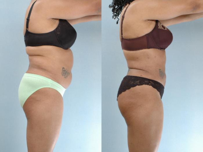 Before & After Liposuction Case 613875210004 Right Side View in Houston, TX