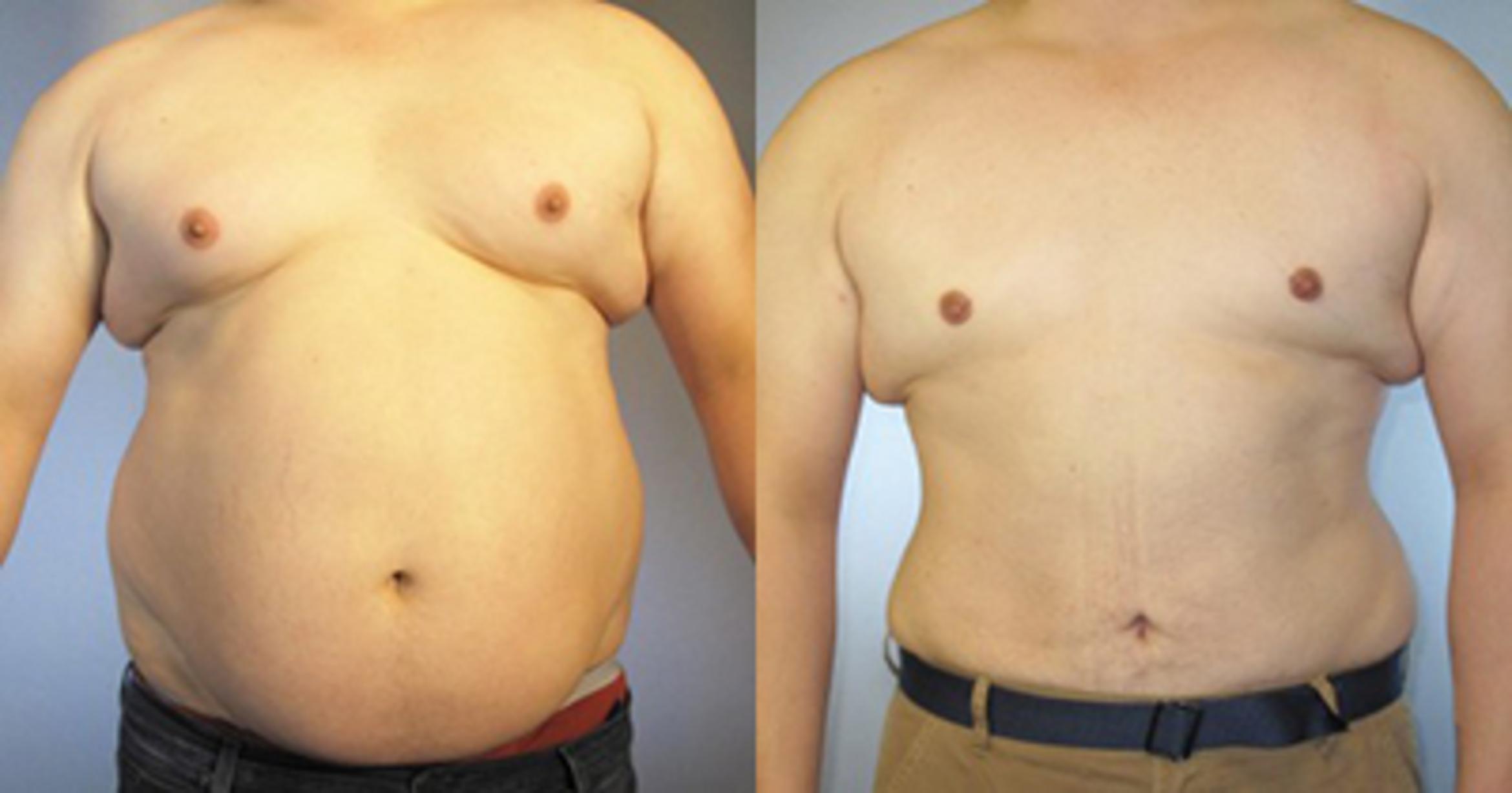 Before & After Liposuction Case 87019999 View 1 View in Houston, TX
