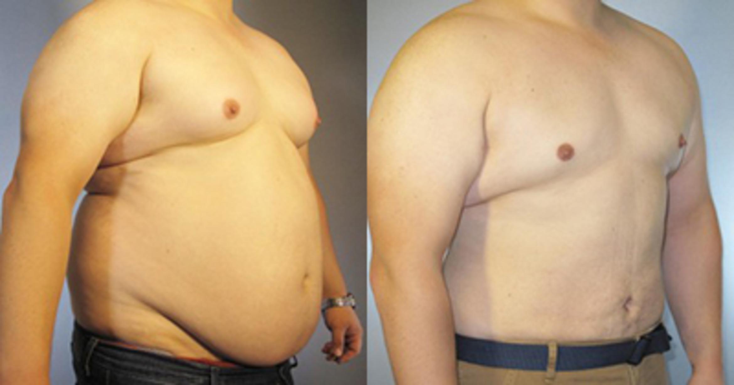 Before & After Liposuction Case 87019999 View 2 View in Houston, TX