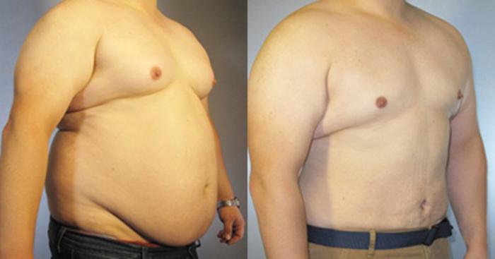 Before & After Liposuction Case 87019999 View 2 View in Houston, TX