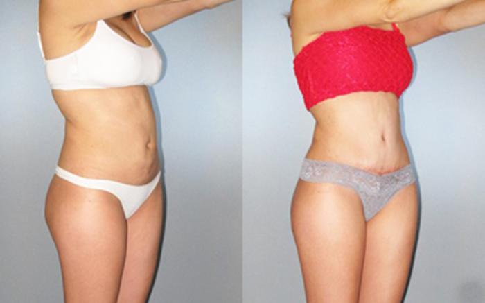 Before & After Liposuction Case 87169999 View 2 View in Houston, TX