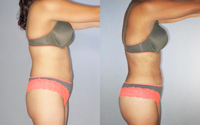 Before & After Liposuction Case 8812 View 1 View in Houston, TX