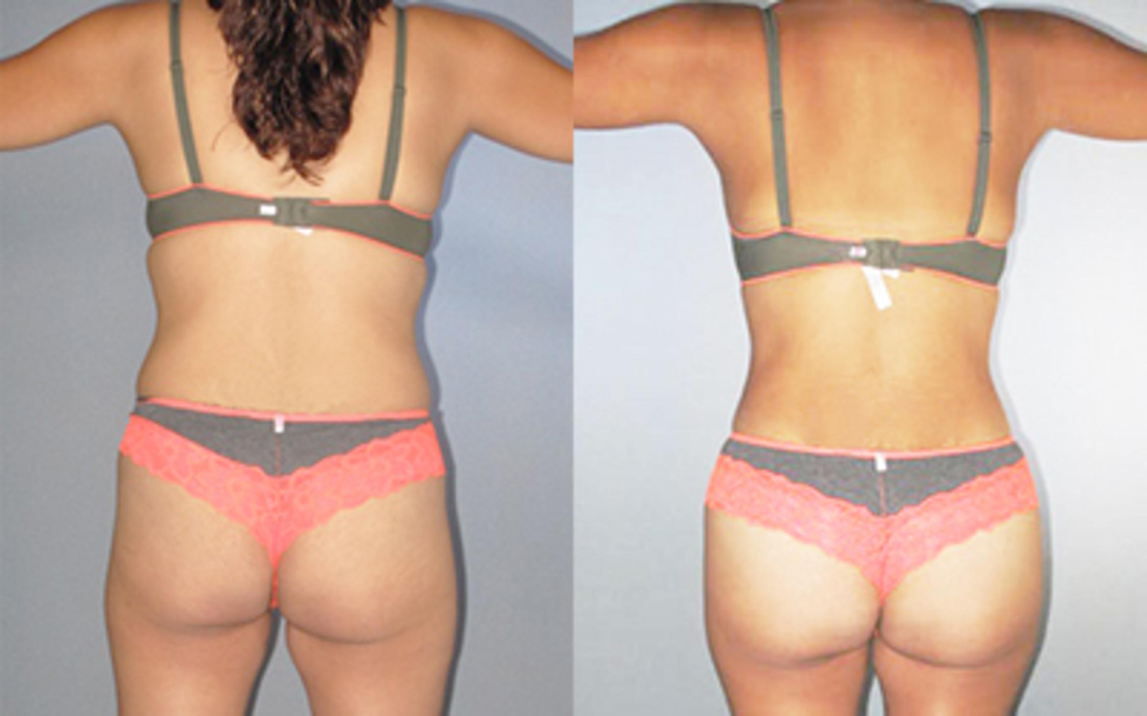 Before & After Liposuction Case 8812 View 2 View in Houston, TX