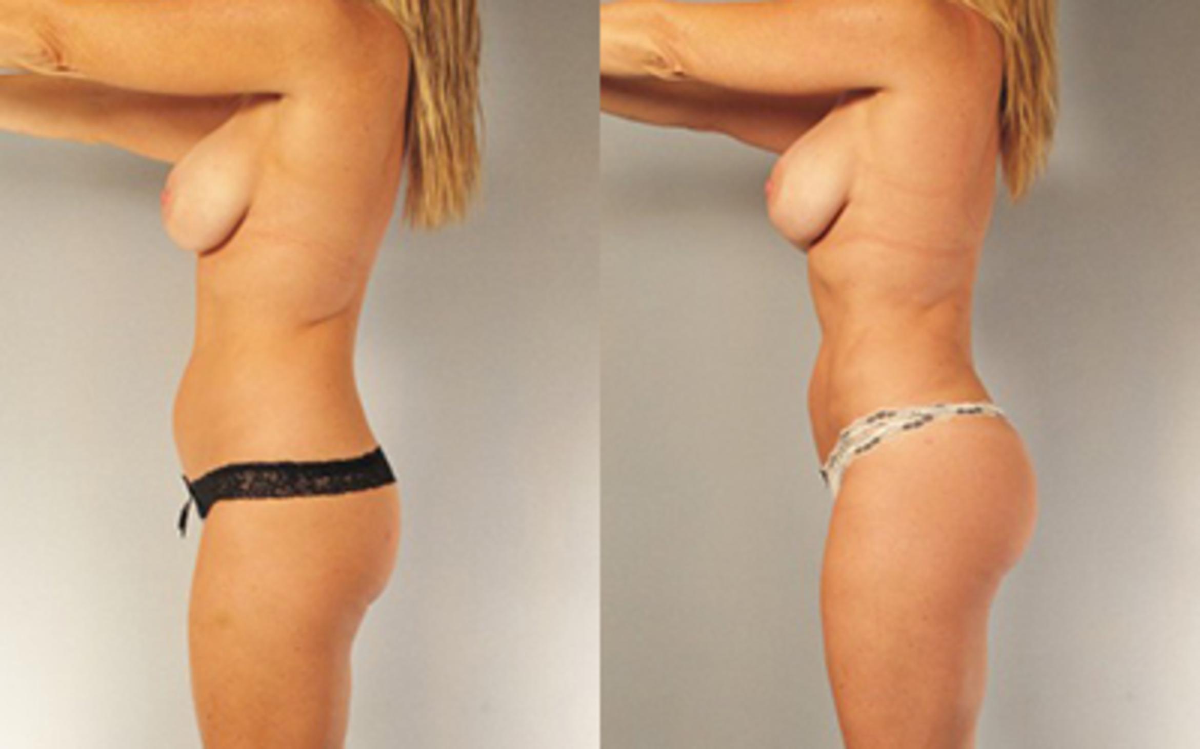 Before & After Liposuction Case 8820 View 2 View in Houston, TX