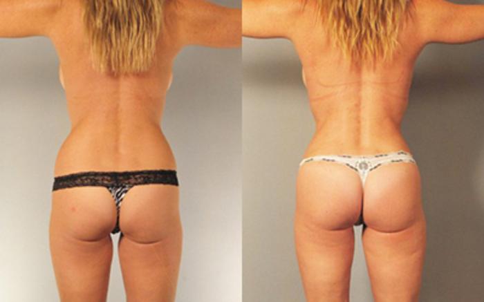 Before & After Liposuction Case 8820 View 3 View in Houston, TX