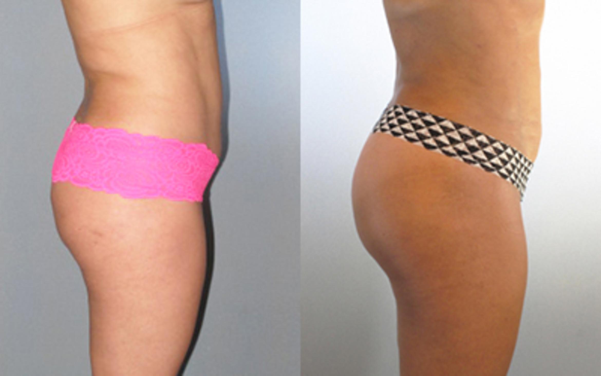 Before & After Liposuction Case 8858 View 1 View in Houston, TX
