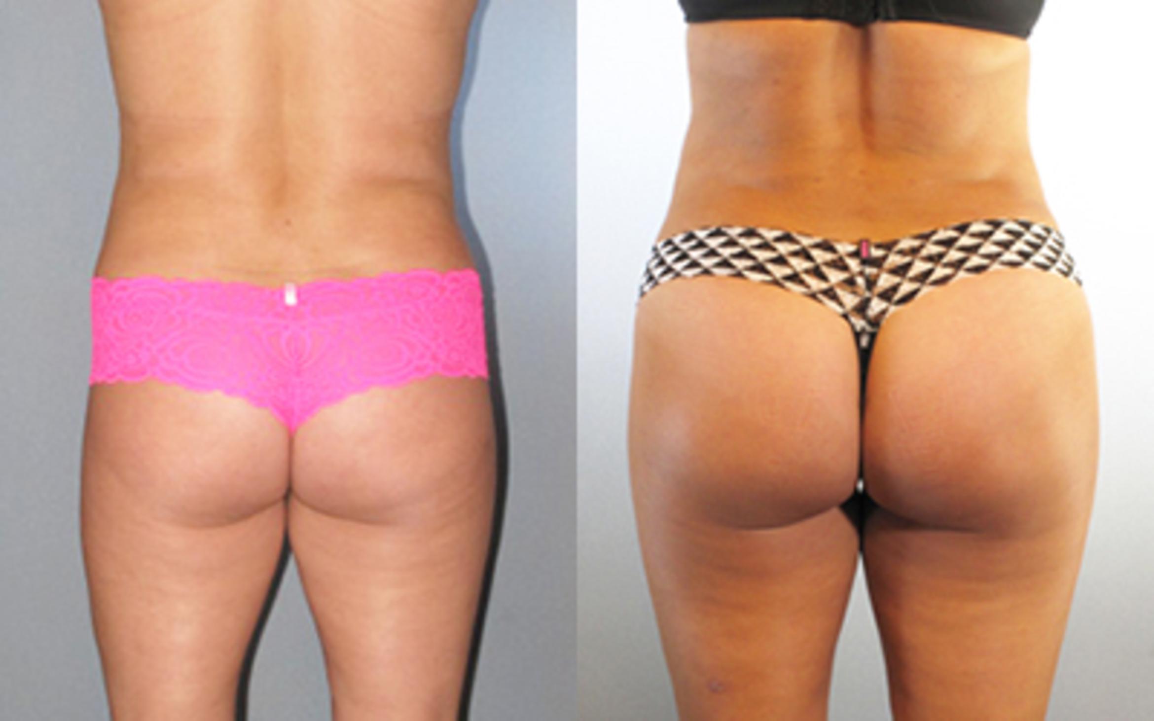 Before & After Liposuction Case 8858 View 2 View in Houston, TX