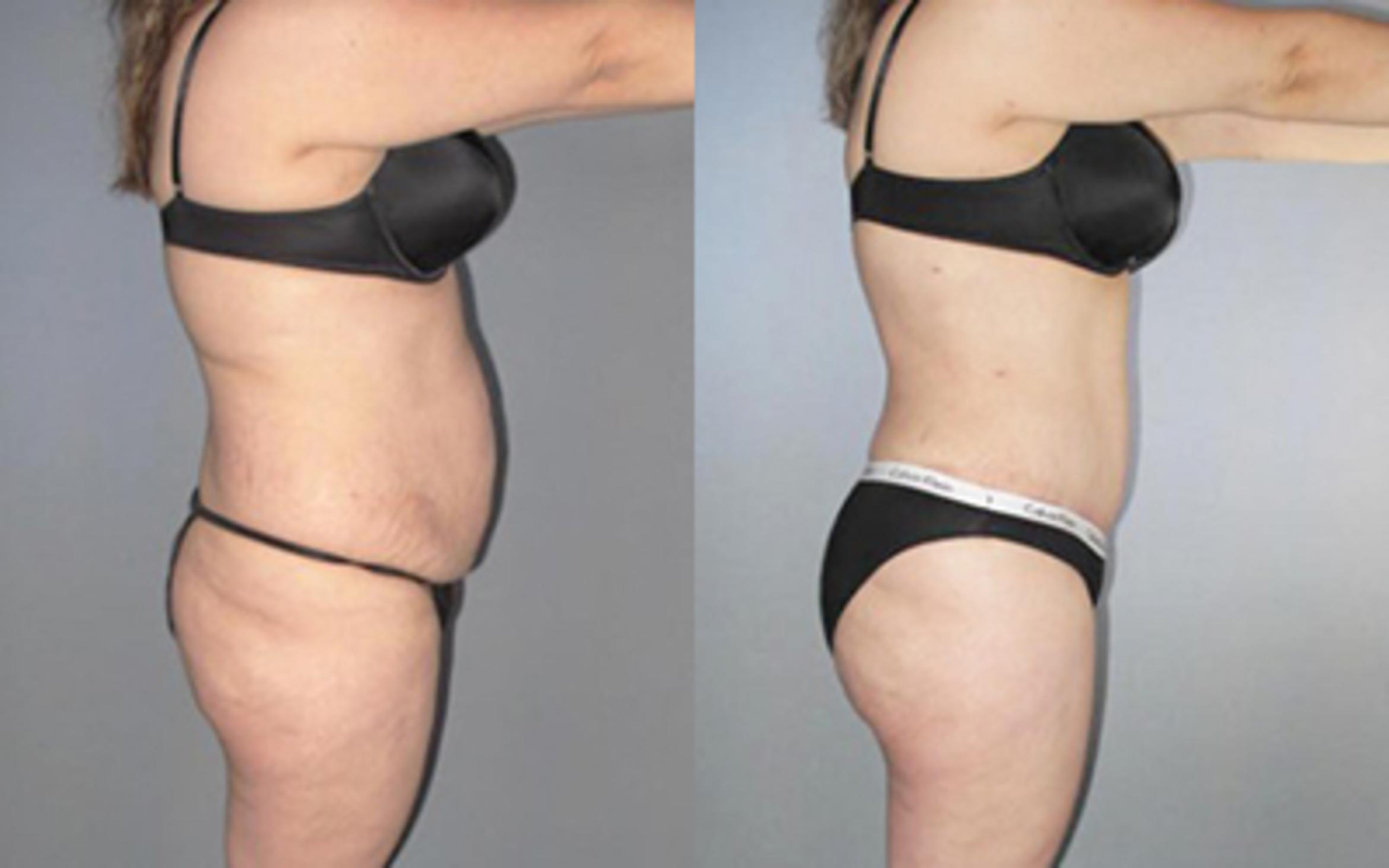 Before & After Liposuction Case 8865 View 2 View in Houston, TX