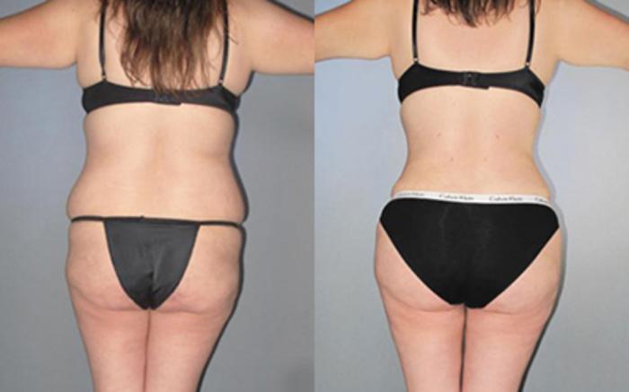 Before & After Liposuction Case 8865 View 3 View in Houston, TX