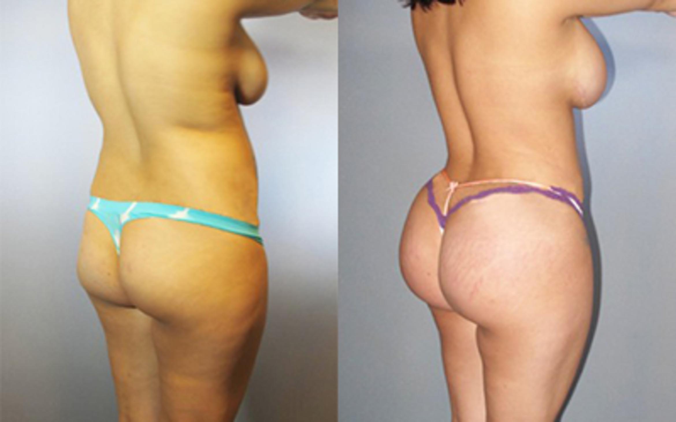 Before & After Liposuction Case 8874 View 1 View in Houston, TX