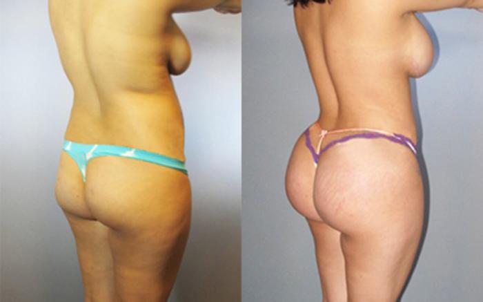 Before & After Liposuction Case 8874 View 1 View in Houston, TX