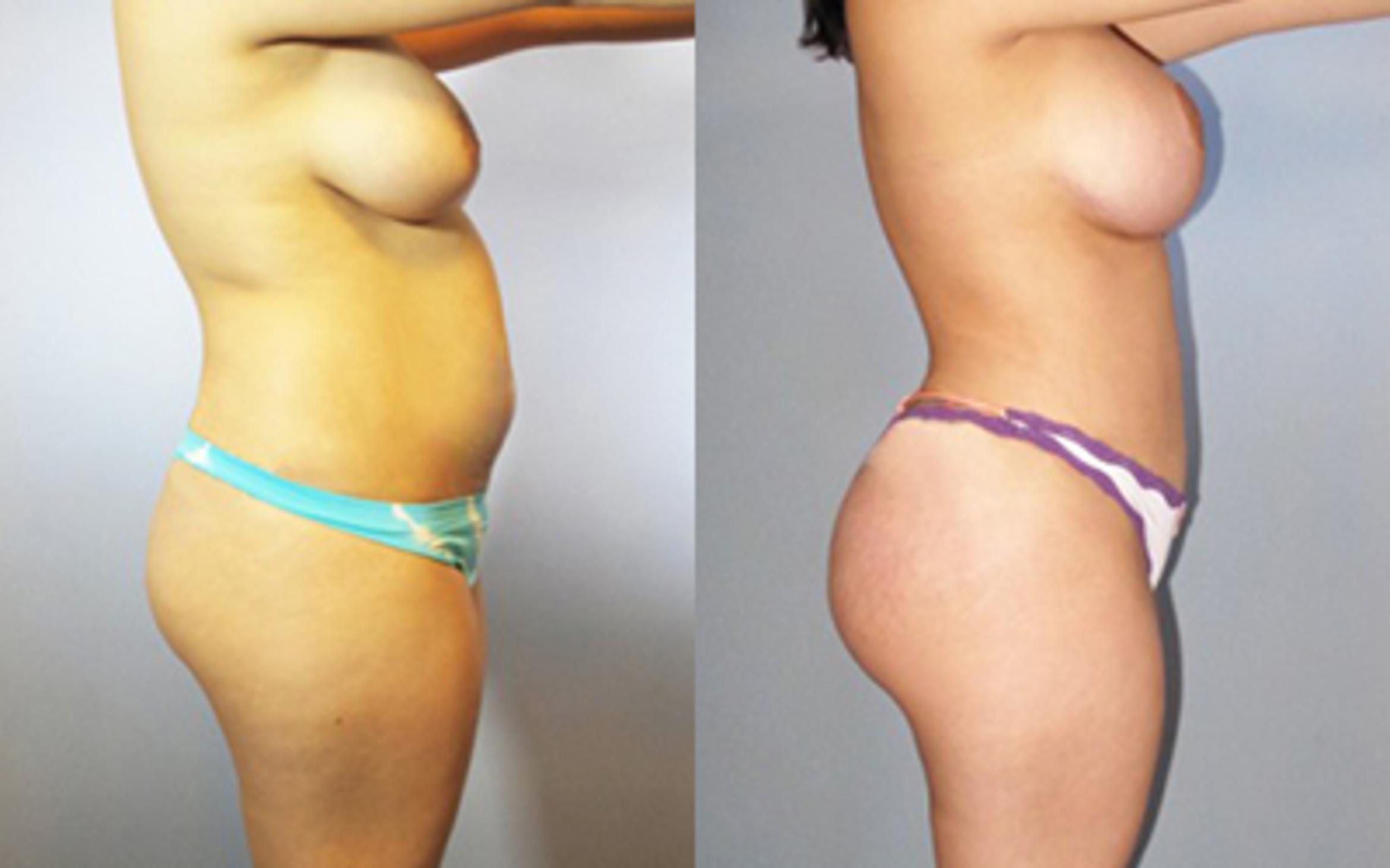 Before & After Liposuction Case 8874 View 2 View in Houston, TX