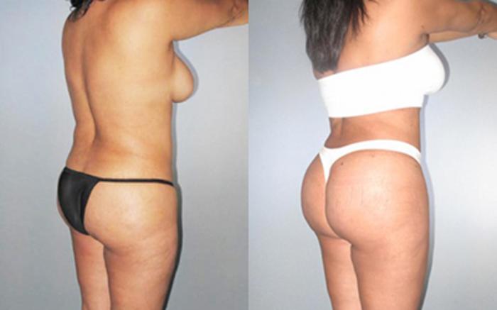 Before & After Liposuction Case 8944 View 1 View in Houston, TX