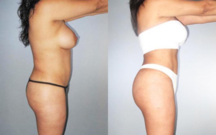 Before & After Liposuction Case 8944 View 2 View in Houston, TX