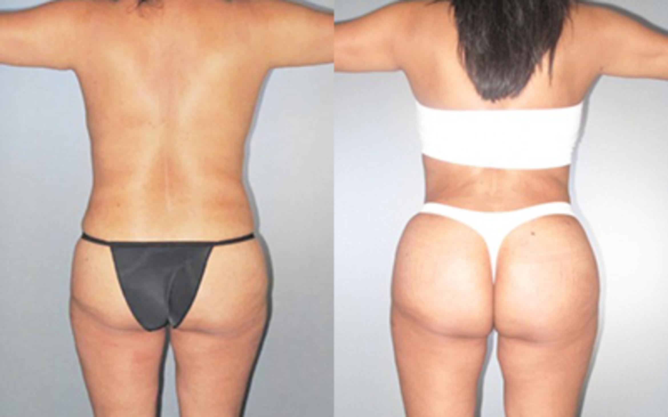 Before & After Liposuction Case 8944 View 3 View in Houston, TX