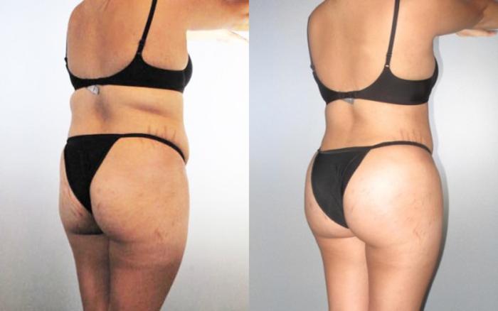 Before & After Liposuction Case 8970 View 1 View in Houston, TX