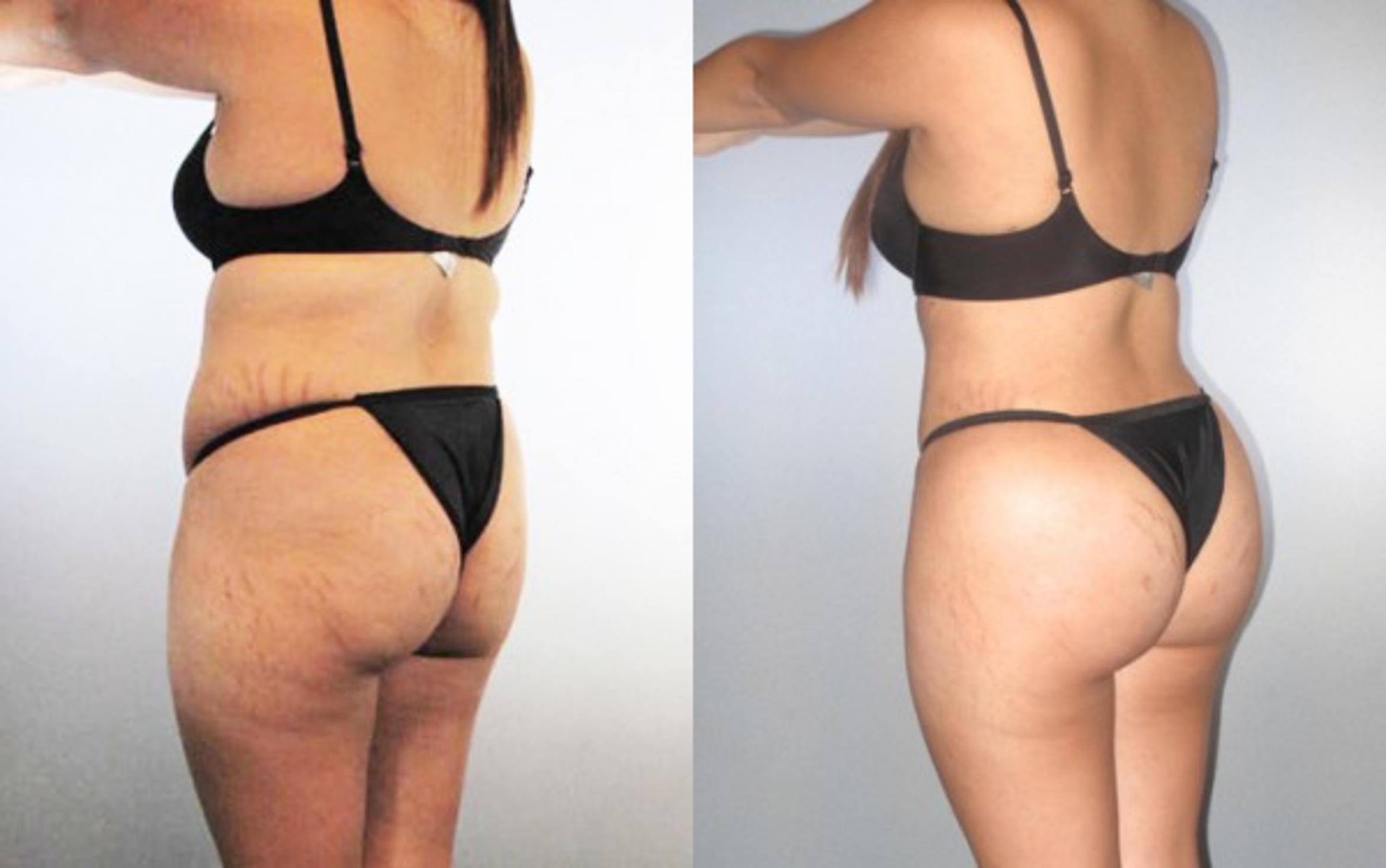 Before & After Liposuction Case 8970 View 2 View in Houston, TX