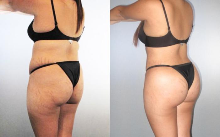 Before & After Liposuction Case 8970 View 2 View in Houston, TX