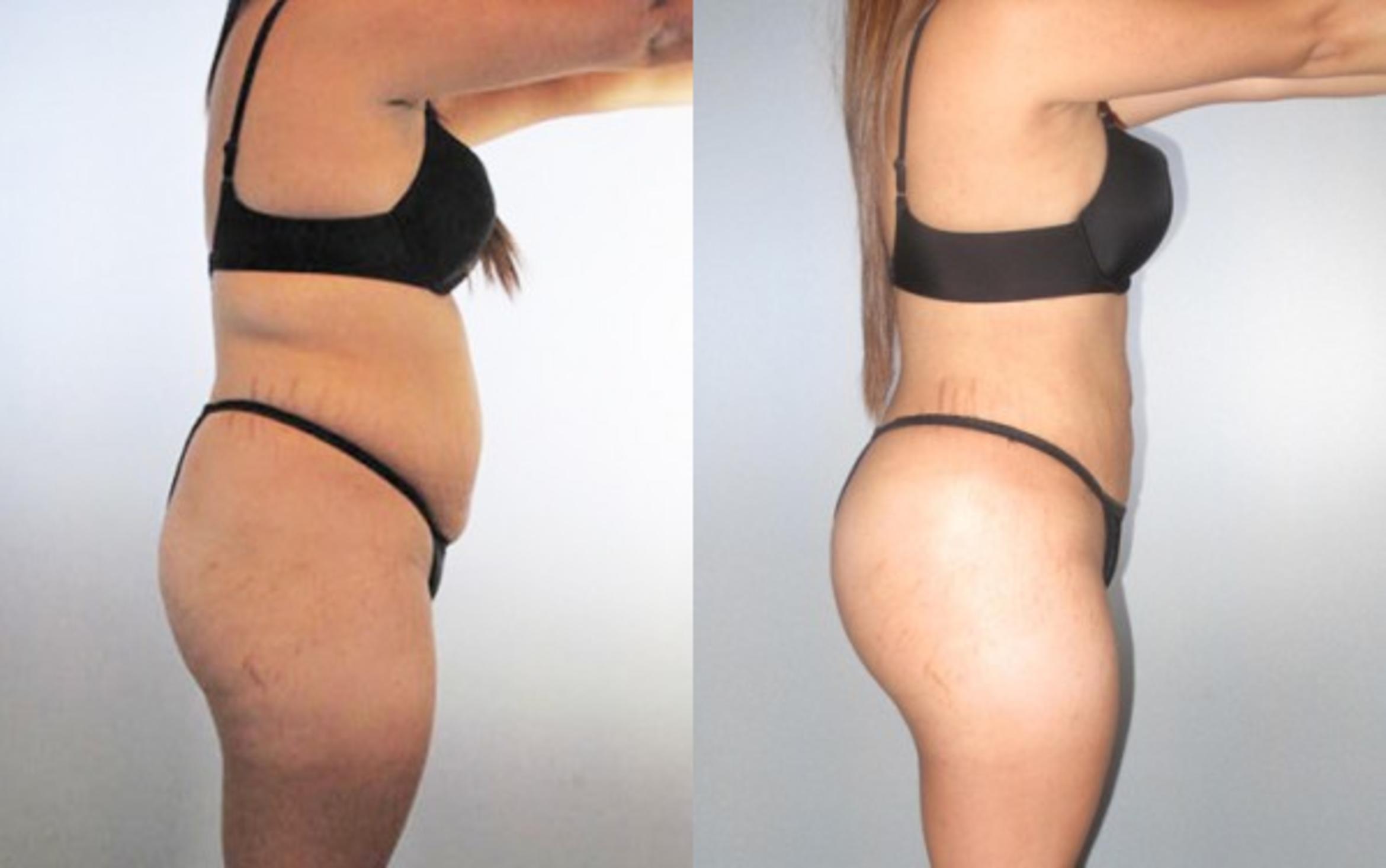 Before & After Liposuction Case 8970 View 3 View in Houston, TX