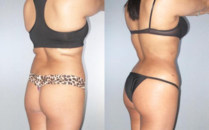 Before & After Liposuction Case 90819999 View 1 View in Houston, TX