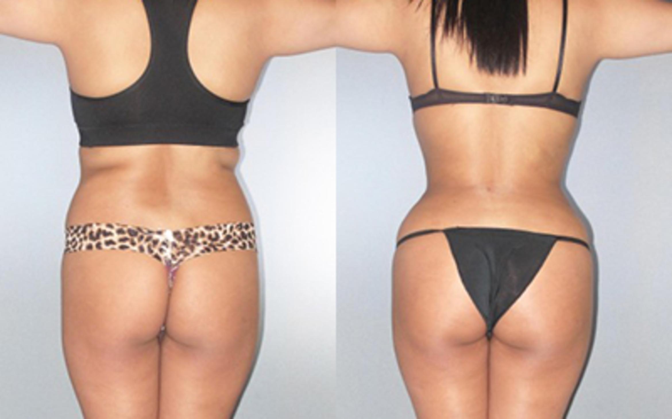 Before & After Liposuction Case 90819999 View 2 View in Houston, TX