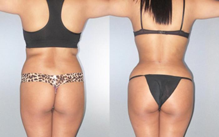 Before & After Liposuction Case 90819999 View 2 View in Houston, TX