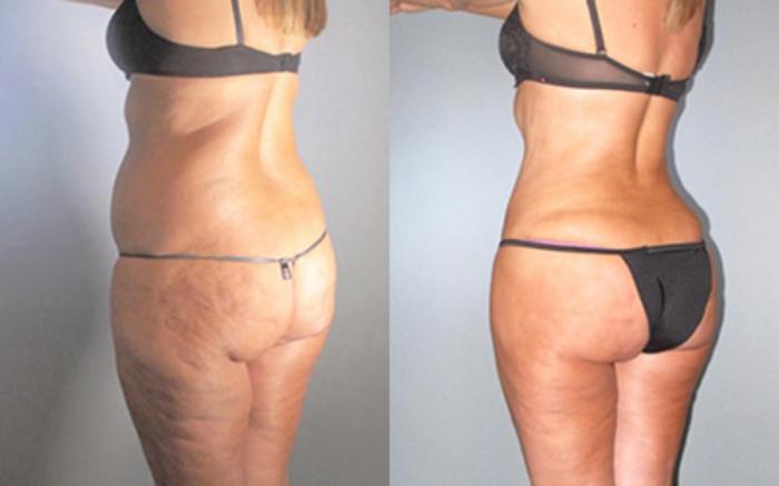 Before & After Liposuction Case 91449999 View 1 View in Houston, TX