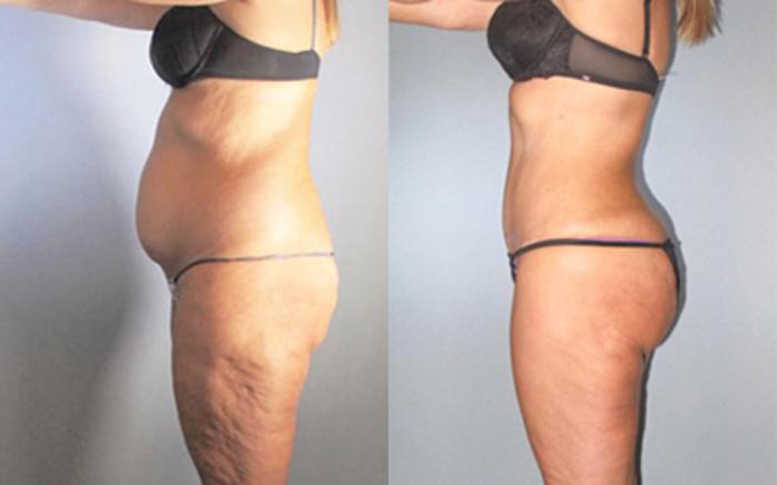 Before & After Liposuction Case 91449999 View 2 View in Houston, TX