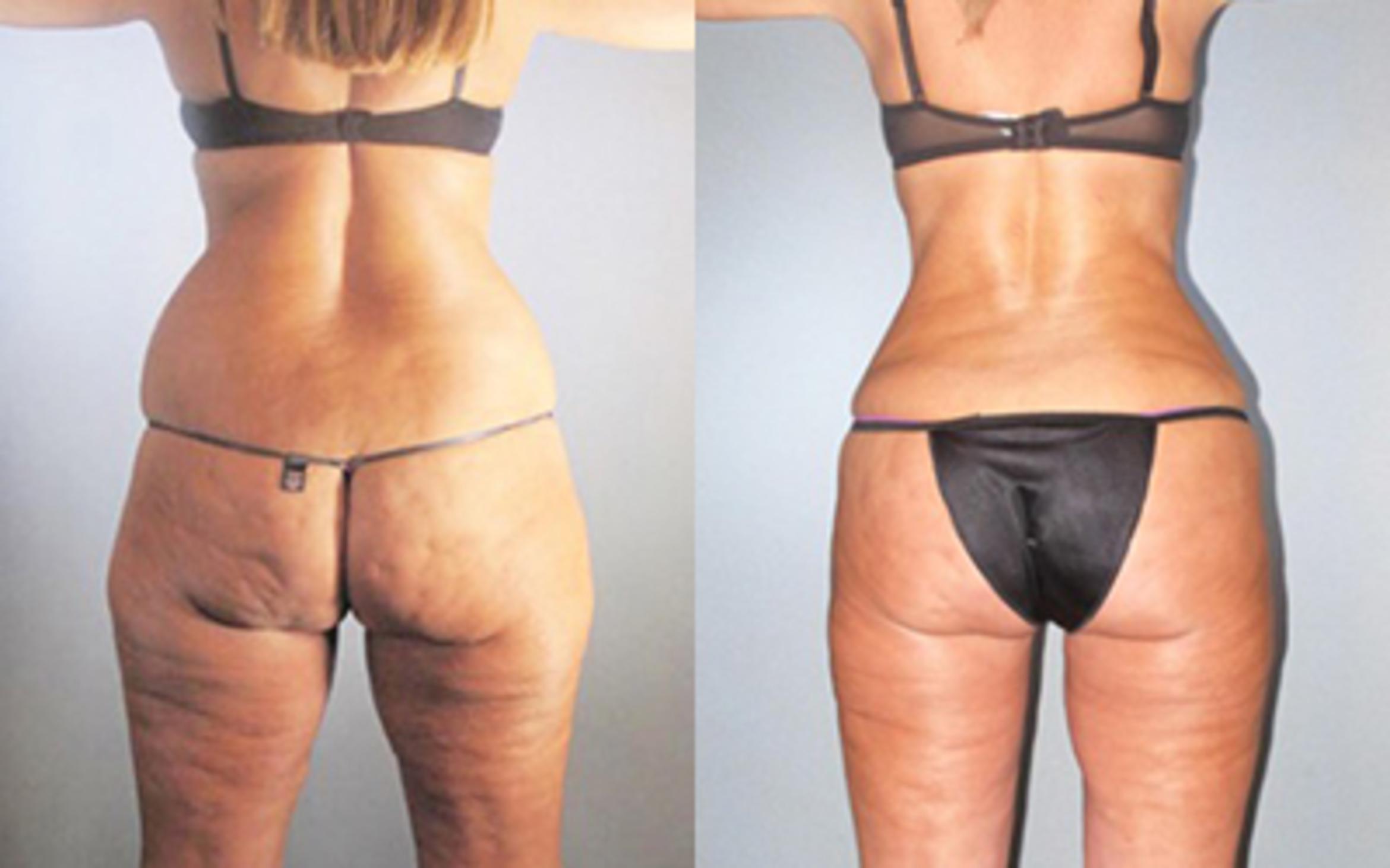 Before & After Liposuction Case 91449999 View 3 View in Houston, TX