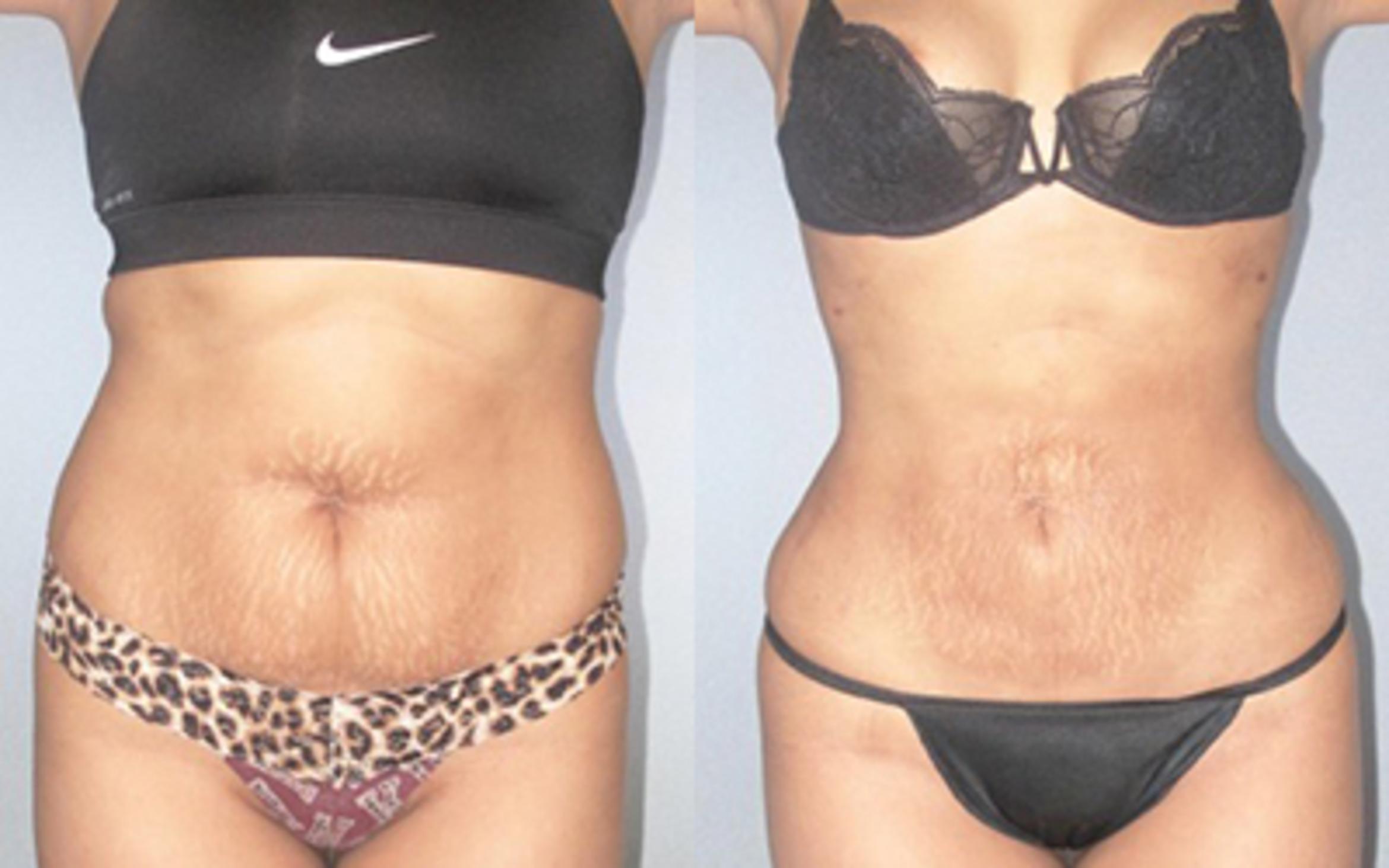Before & After Liposuction Case 9153 View 1 View in Houston, TX