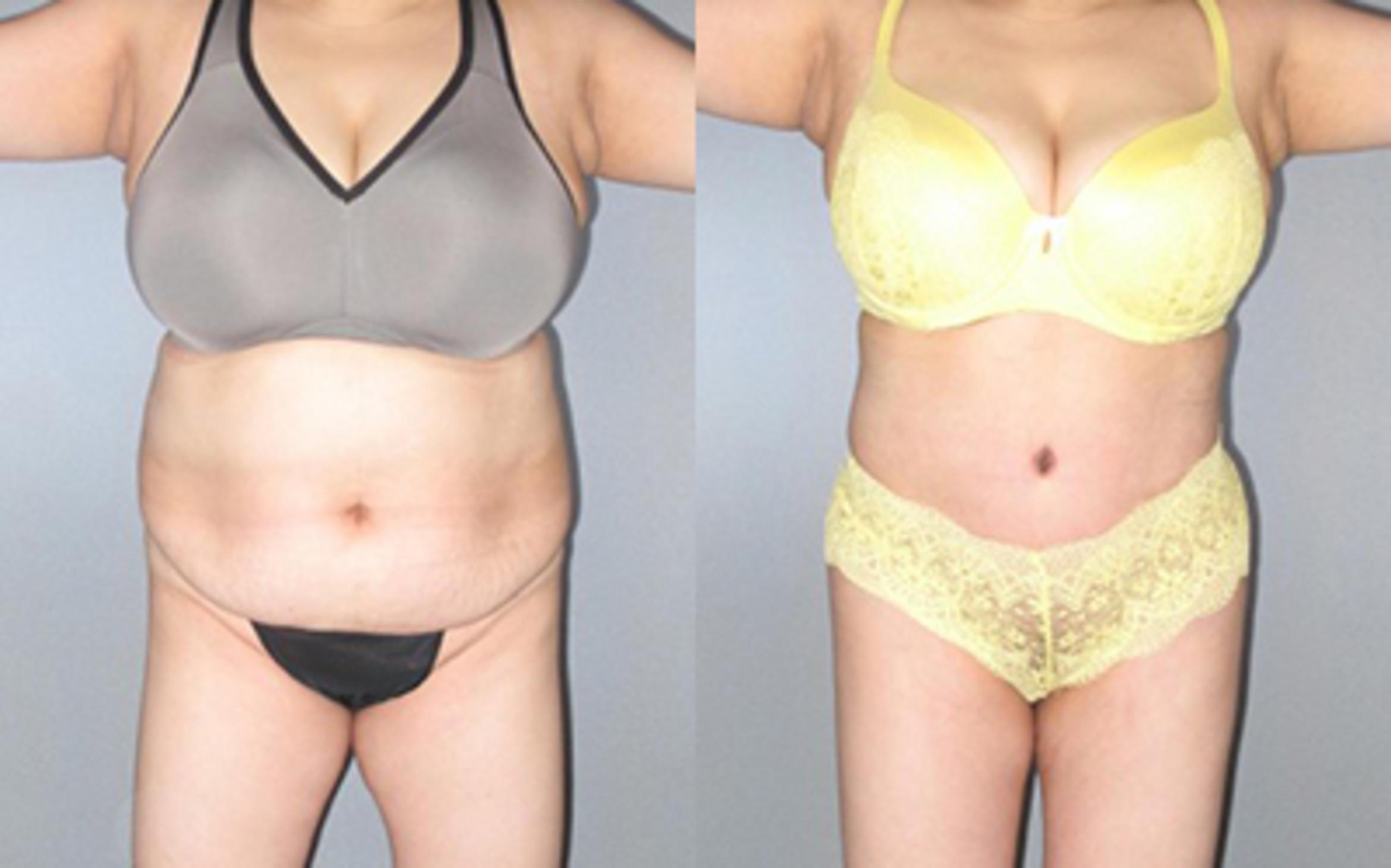 Before & After Liposuction Case 91999999 View 1 View in Houston, TX