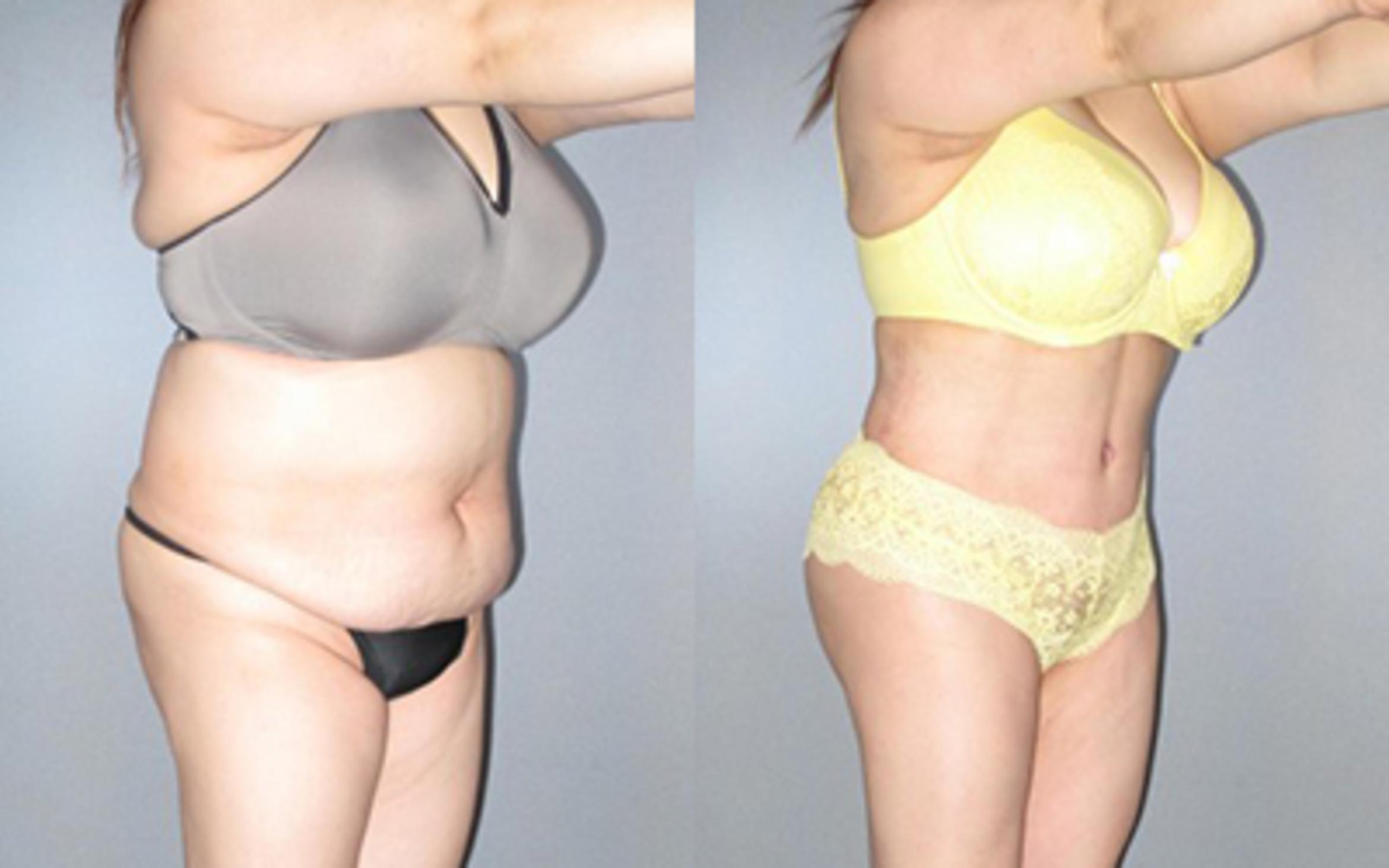 Before & After Liposuction Case 91999999 View 2 View in Houston, TX