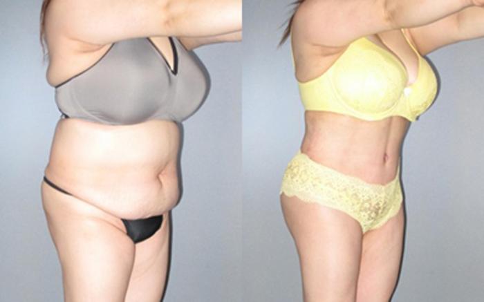 Before & After Liposuction Case 91999999 View 2 View in Houston, TX