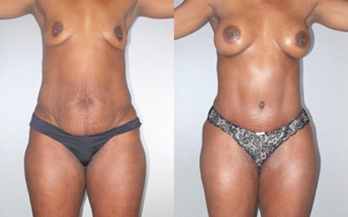 Before & After Liposuction Case 92519998 View 1 View in Houston, TX