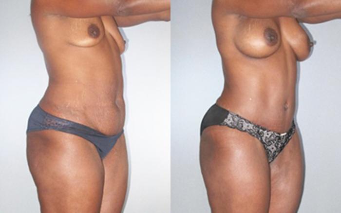 Before & After Liposuction Case 92519998 View 2 View in Houston, TX