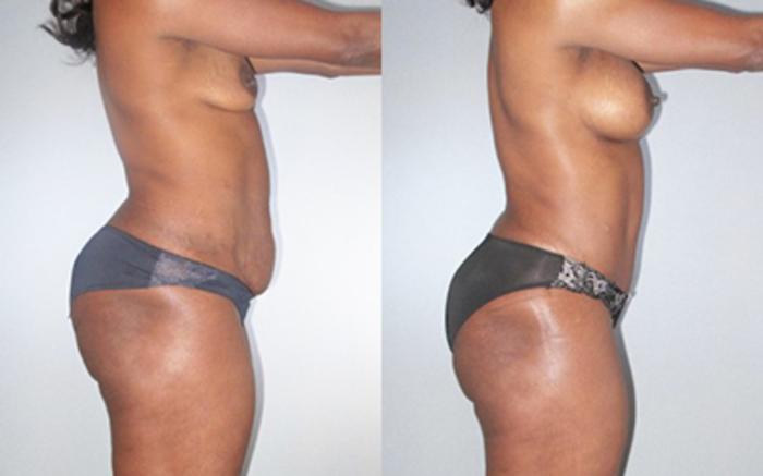 Before & After Liposuction Case 92519998 View 3 View in Houston, TX