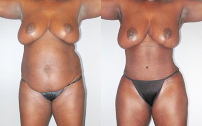 Before & After Liposuction Case 92809999 View 1 View in Houston, TX