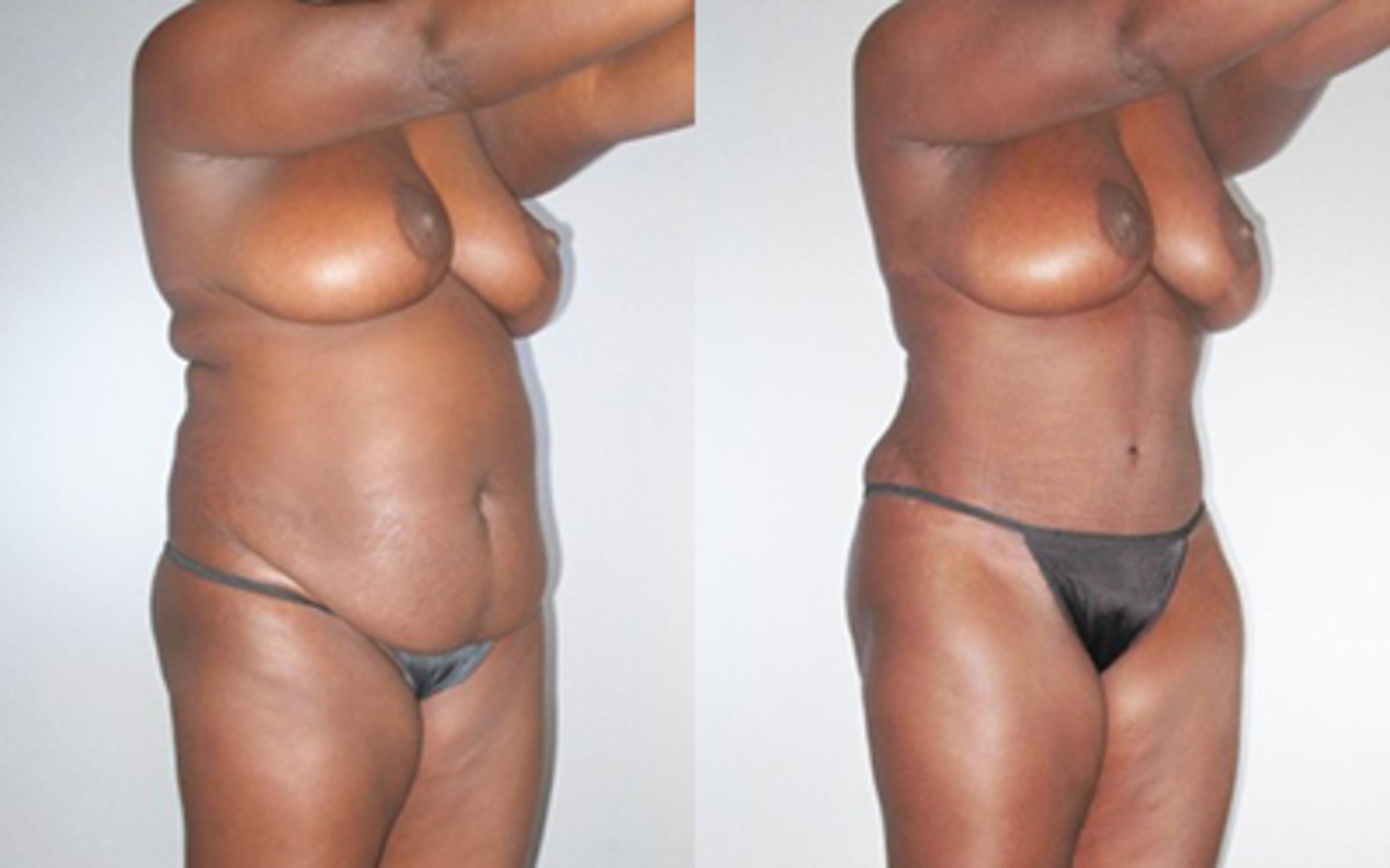 Before & After Liposuction Case 92809999 View 2 View in Houston, TX