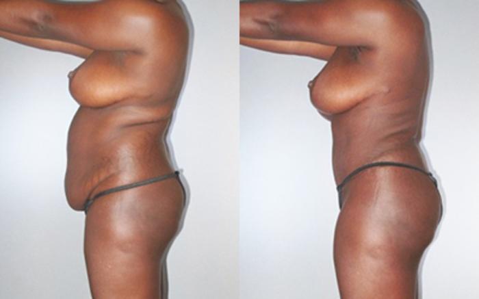 Before & After Liposuction Case 92809999 View 3 View in Houston, TX