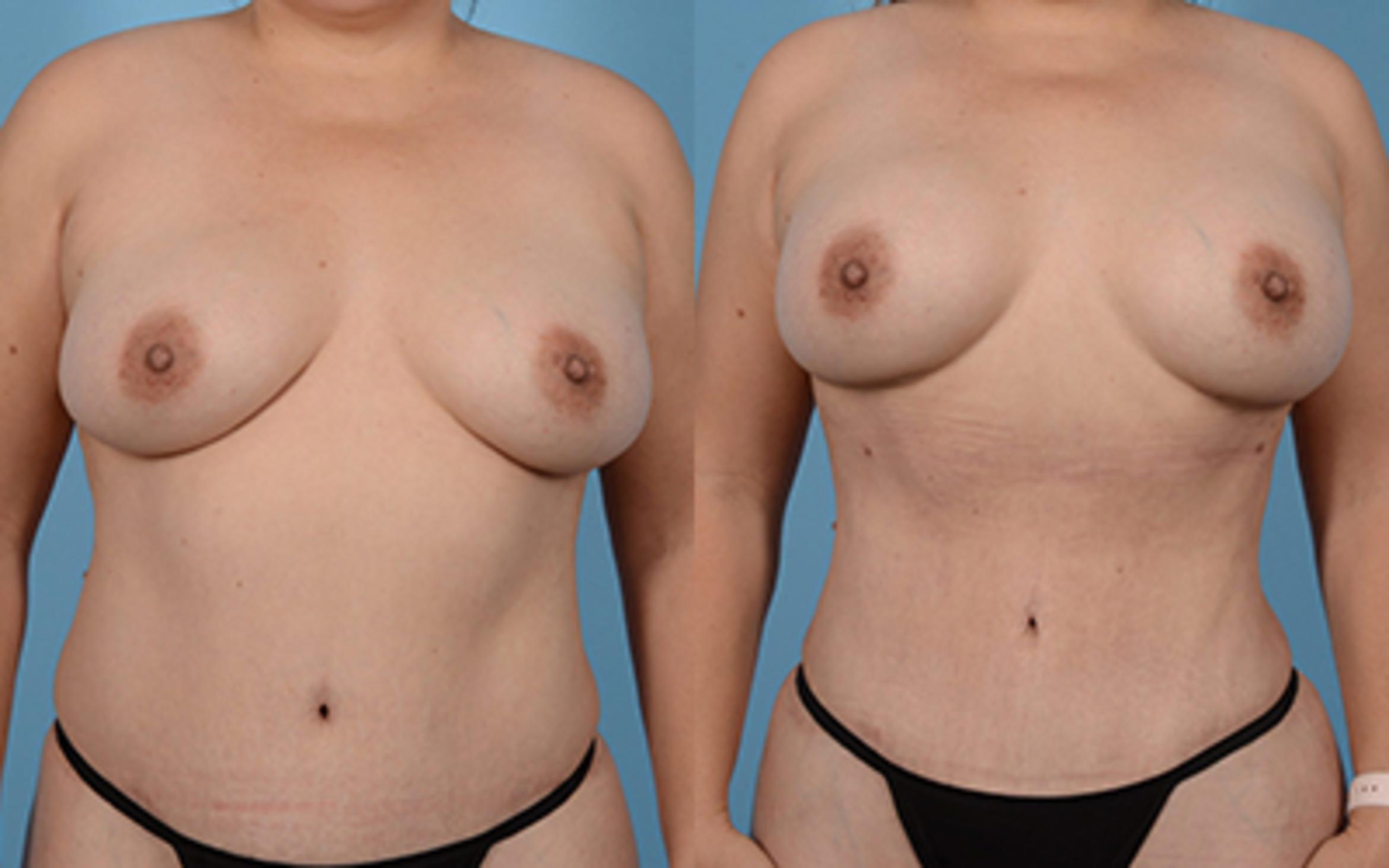 Before & After Liposuction Case 94907 View 1 View in Houston, TX